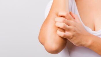 tips para lidiar con la dermatitis